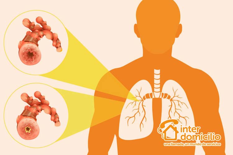 bronquitis-y-neumonia-en-ancianos